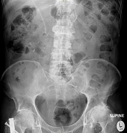 Plastic biliary stent | Image | Radiopaedia.org