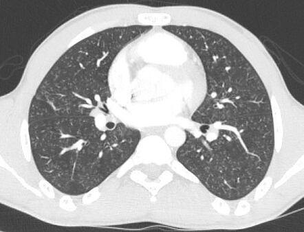 Cocaine-induced pneumonitis | Radiology Case | Radiopaedia.org