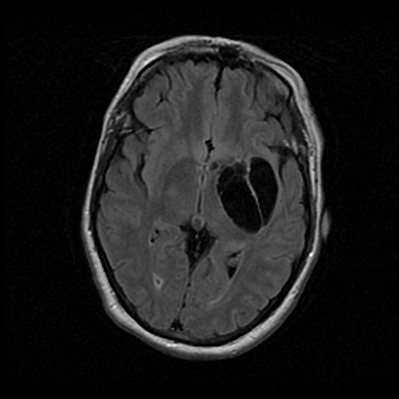 Tumefactive perivascular spaces | Radiology Reference Article ...