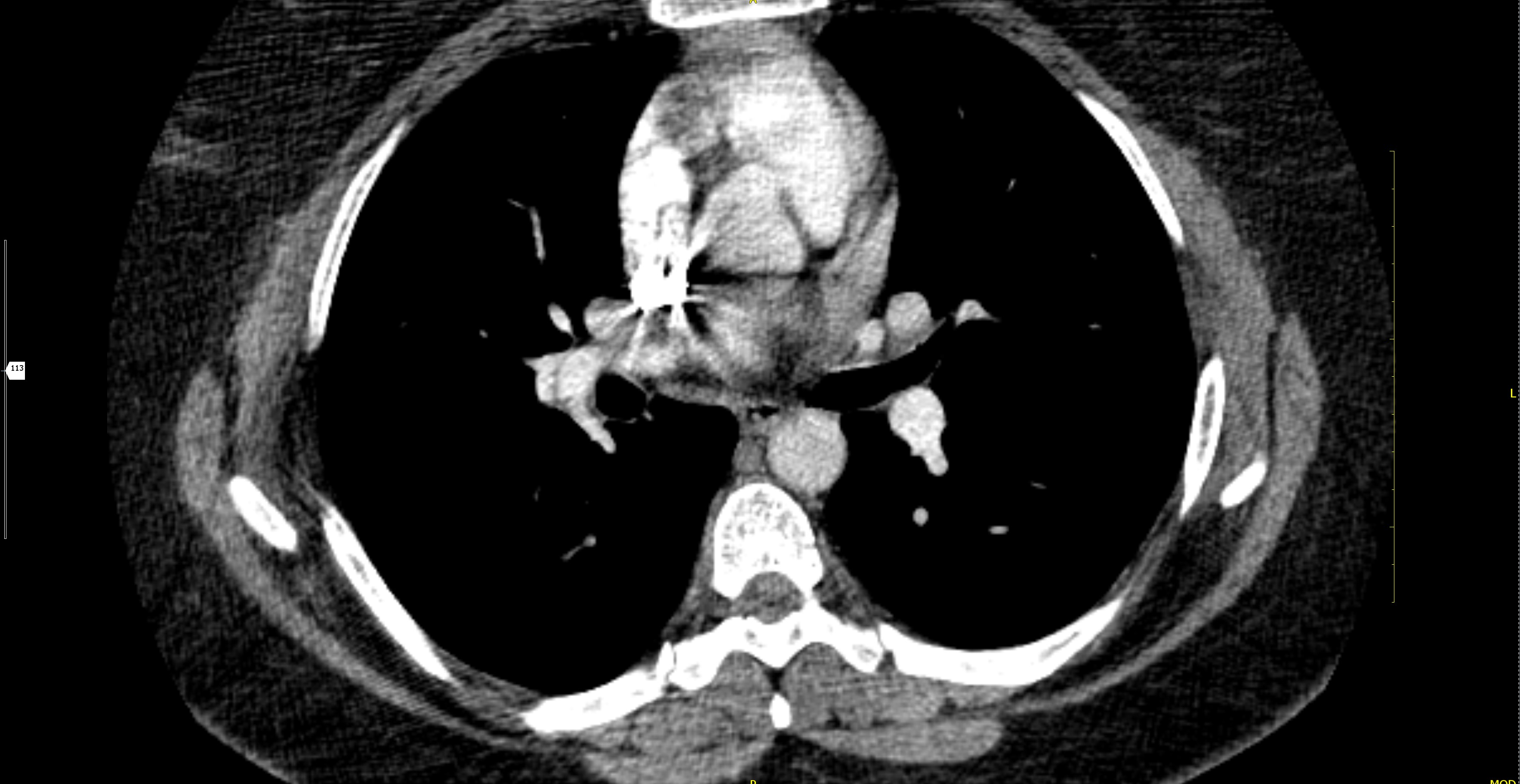 Chronic Pulmonary Thromboembolism 