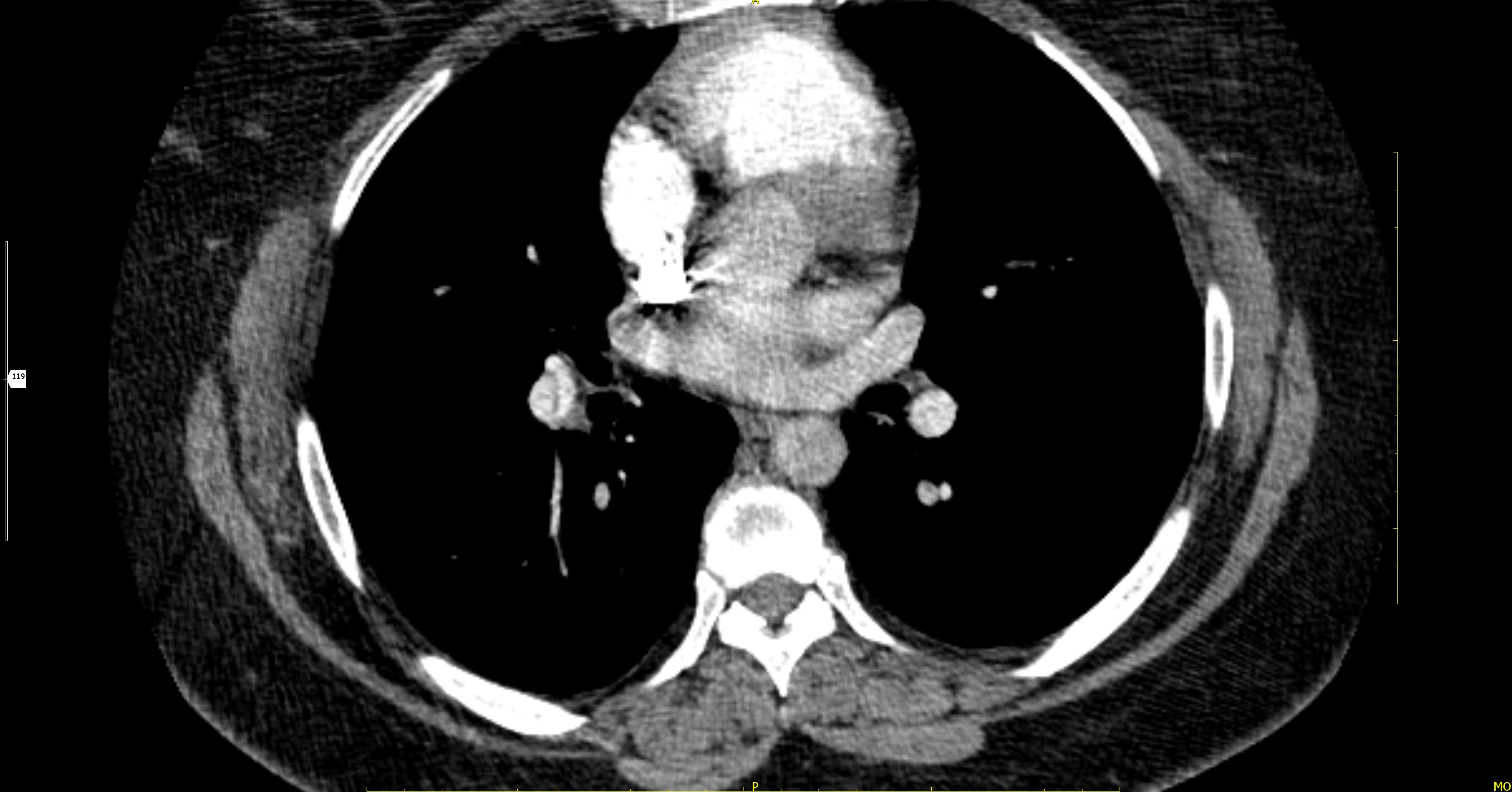 Chronic Pulmonary Thromboembolism Image