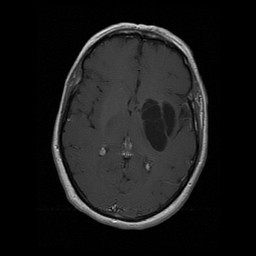 Tumefactive perivascular spaces | Image | Radiopaedia.org