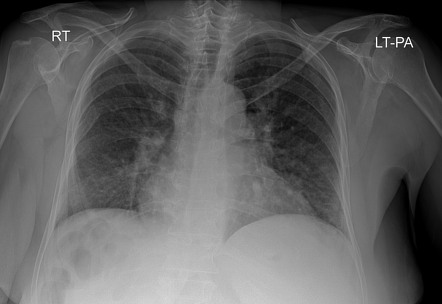 Kerley B Lines | Radiology Case | Radiopaedia.org