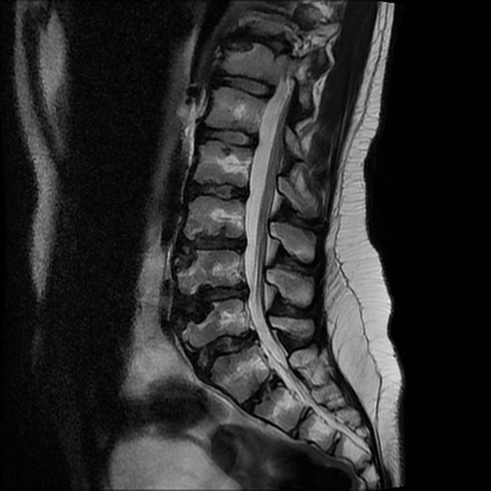 Scheuermann's disease | Radiology Case | Radiopaedia.org