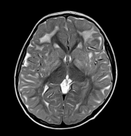 L 2 Hydroxyglutaric Aciduria Radiology Case Radiopaedia Org   8f28df3bc561449c53c3e67fc4981711467f73b7556b9f5f8bf95962037df031 Gallery 