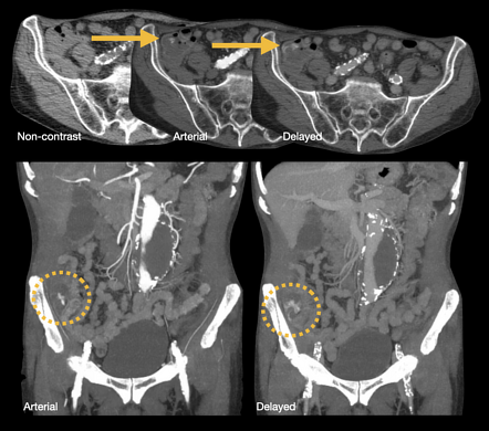 Angiodysplasia