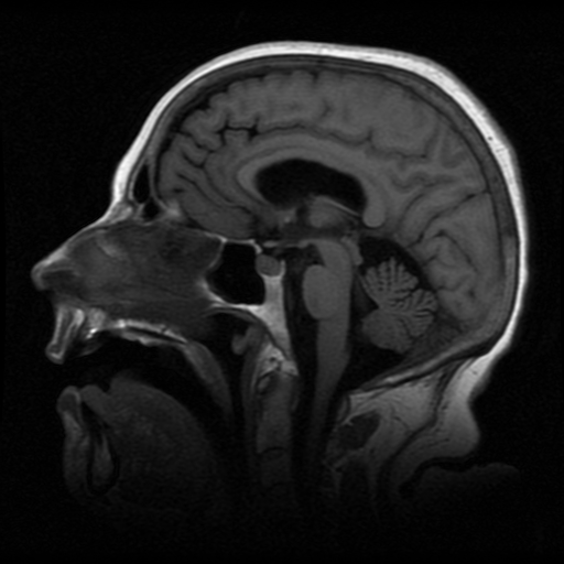 Posterior reversible encephalopathy syndrome (PRES) | Image ...