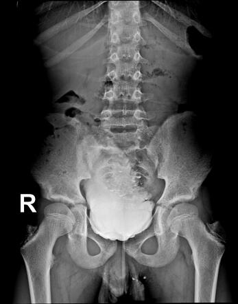 Neurogenic bladder | Radiology Case | Radiopaedia.org