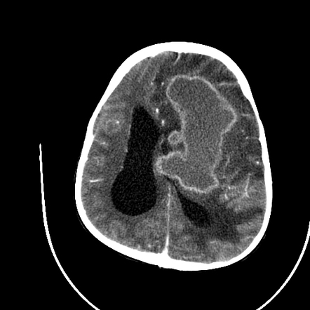 Giant cerebral tuberculoma | Radiology Case | Radiopaedia.org