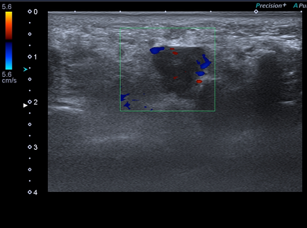 Morton's neuroma | Radiology Case | Radiopaedia.org