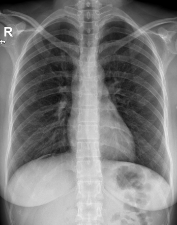 Postoperative pneumoperitoneum | Radiology Case | Radiopaedia.org