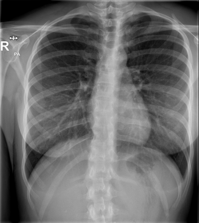 Renal stone (chest X-ray) | Radiology Case | Radiopaedia.org