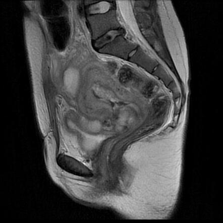 Uterine suture dehiscence and abscess formation | Radiology Case ...