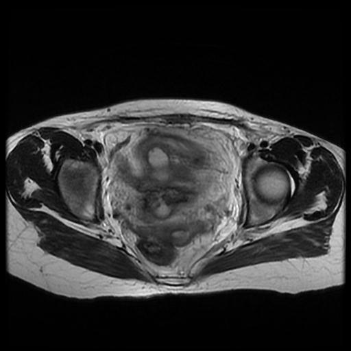 Uterine suture dehiscence and abscess formation | Image | Radiopaedia.org