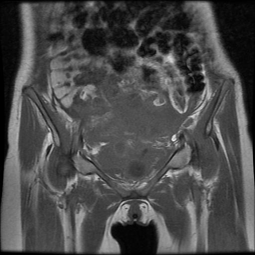 Uterine suture dehiscence and abscess formation | Image | Radiopaedia.org