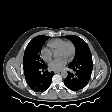 Pulmonary hamartoma | Radiology Case | Radiopaedia.org