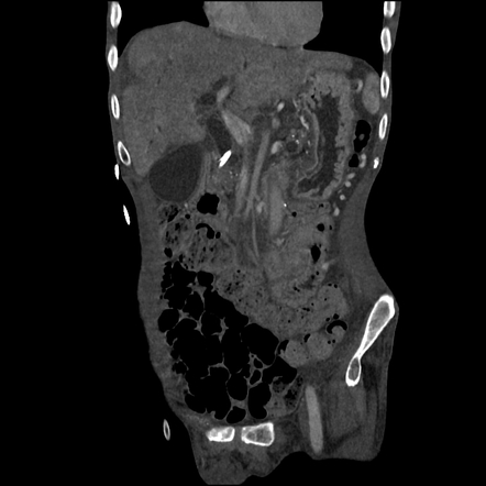 Common bile duct stent | Radiology Case | Radiopaedia.org