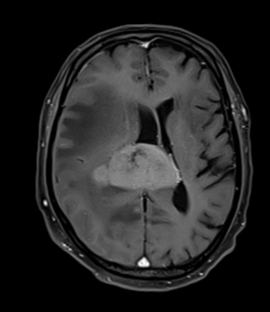 Multiple Cns Lymphoma 