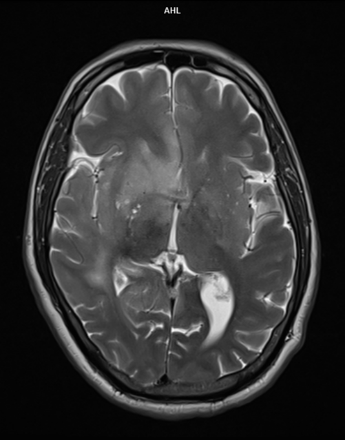 Uremic Encephalopathy | Image | Radiopaedia.org