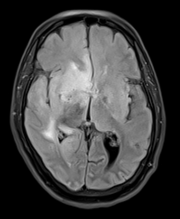 Uremic Encephalopathy | Radiology Reference Article | Radiopaedia.org