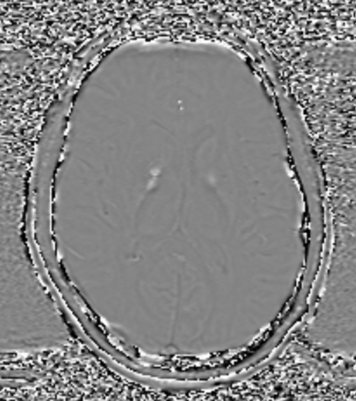 Uremic Encephalopathy | Image | Radiopaedia.org