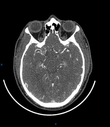 Moyamoya syndrome associated with type I diabetes mellitus | Radiology ...