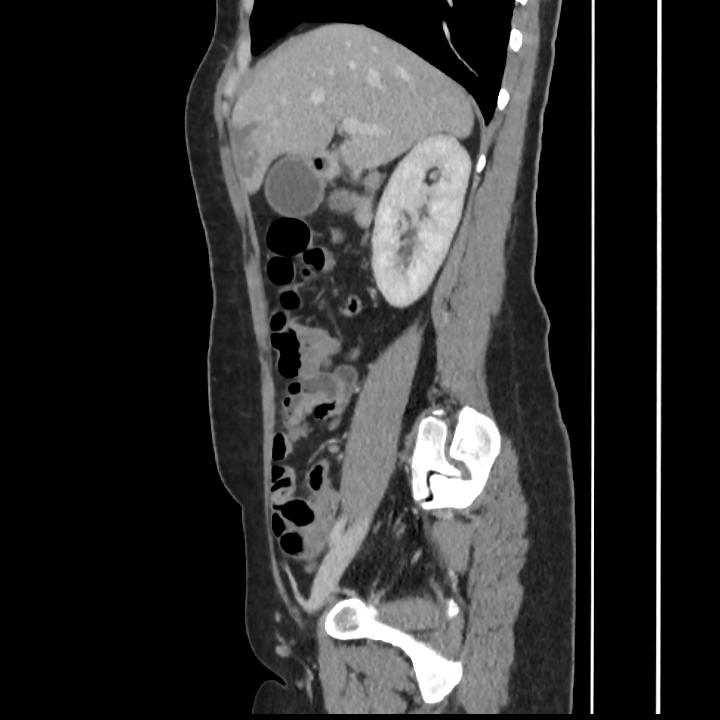 Gastric duplication cyst | Image | Radiopaedia.org