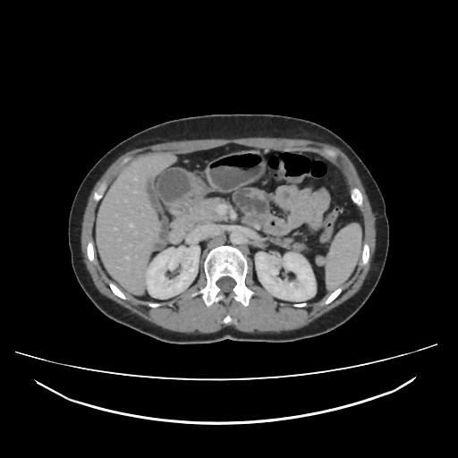 Gastric duplication cyst | Image | Radiopaedia.org