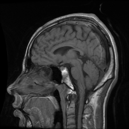 Crossed cerebellar diaschisis | Image | Radiopaedia.org