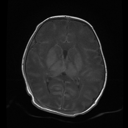 Hypoxic encephalopathy | Radiology Case | Radiopaedia.org