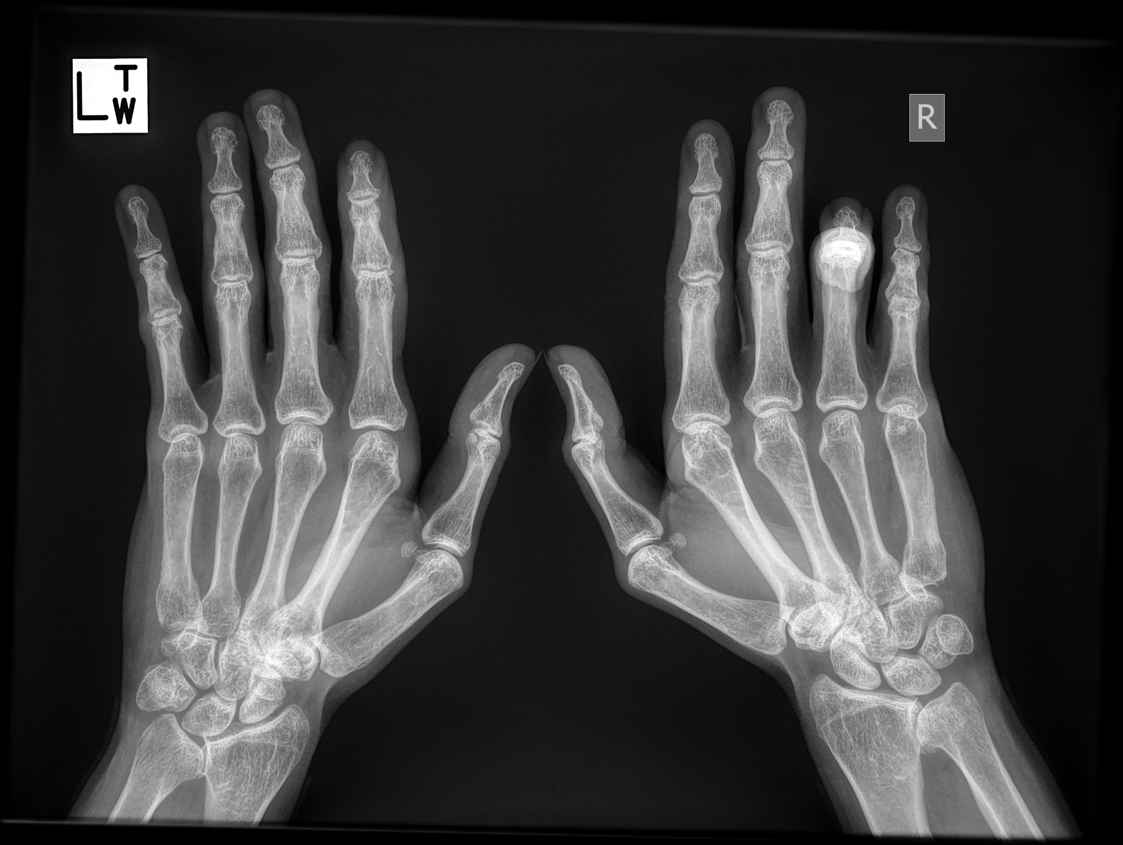 File:Turner syndrome - Madelung deformity, short 4th metacarpal and ...