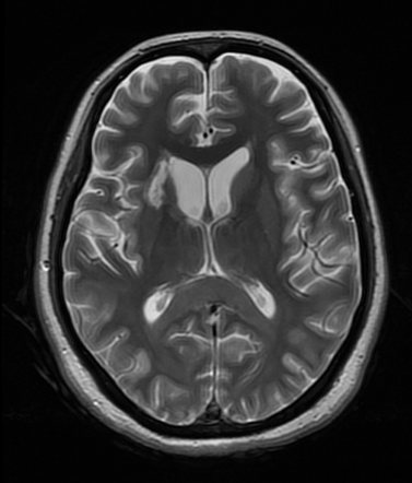 Hypoglycemic encephalopathy | Image | Radiopaedia.org