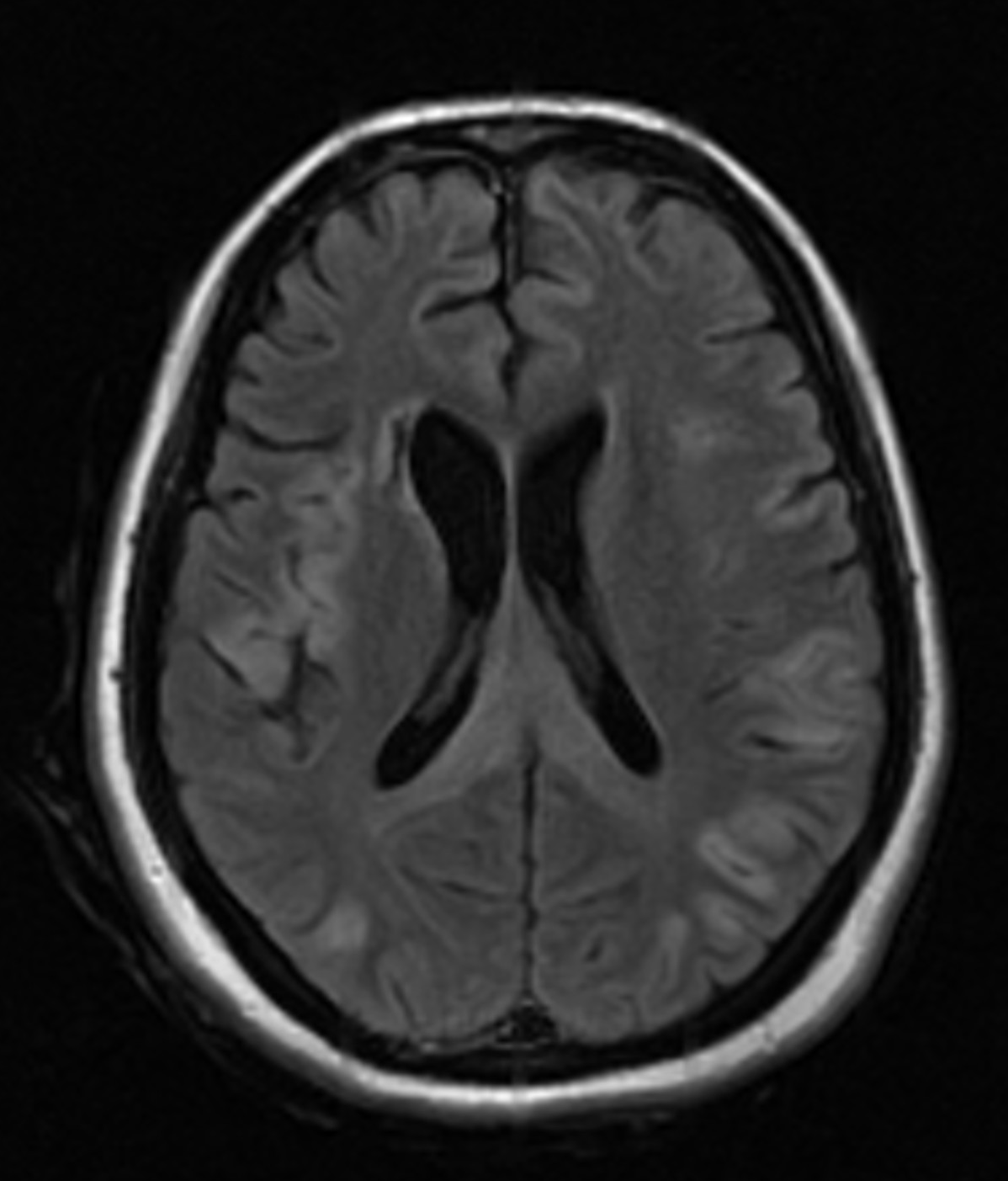 Hypoglycemic encephalopathy | Image | Radiopaedia.org