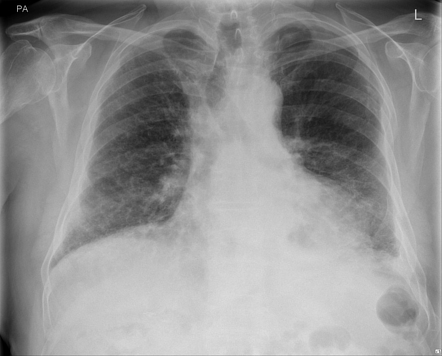 Thoracic splenosis | Radiology Case | Radiopaedia.org