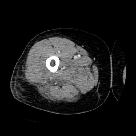 Infectious myositis | Radiology Case | Radiopaedia.org