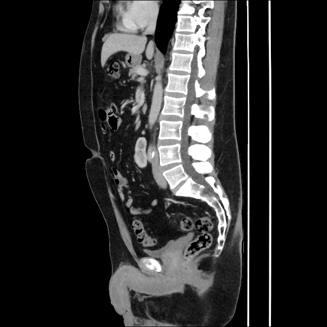 Horseshoe kidney Image