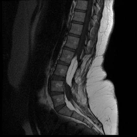 Intradural lipoma | Radiology Case | Radiopaedia.org