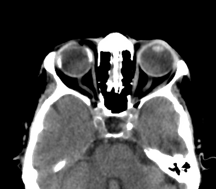 Scleral buckle surgery | Radiology Case | Radiopaedia.org