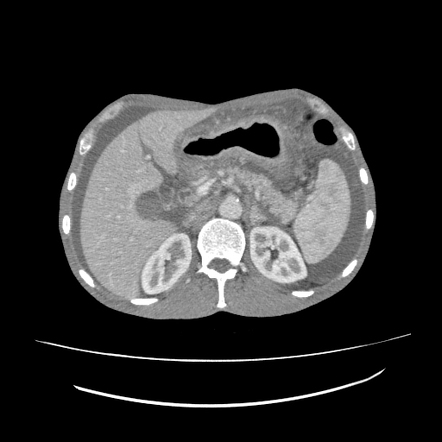 Poorly Cohesive Carcinoma Of The Stomach Radiology Case Radiopaedia Org