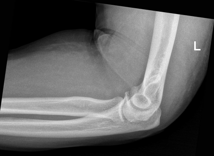 Coronoid fracture - elbow | Radiology Case | Radiopaedia.org