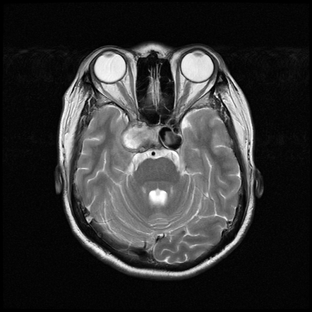 Bilateral cavernous segments internal carotid artery aneurysms ...