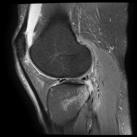 Wrisberg rip | Radiology Case | Radiopaedia.org