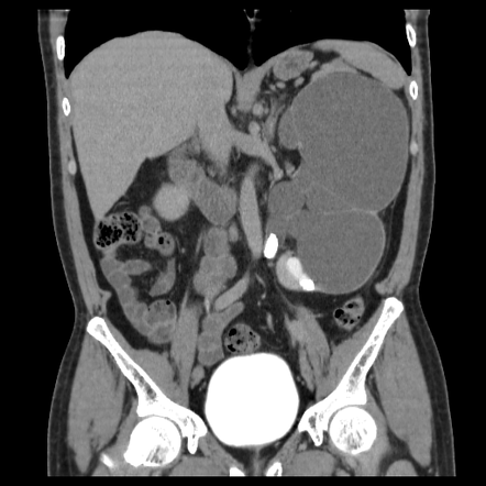 Obstructive Uropathy | Radiology Case | Radiopaedia.org