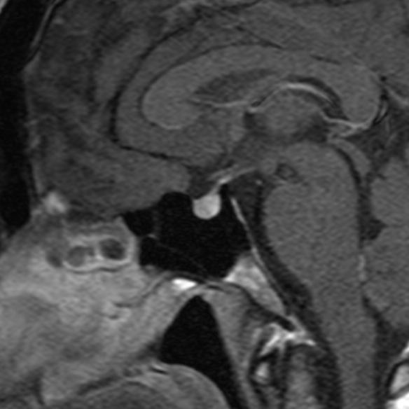 Posterior Pituitary Bright Spot Normal Image