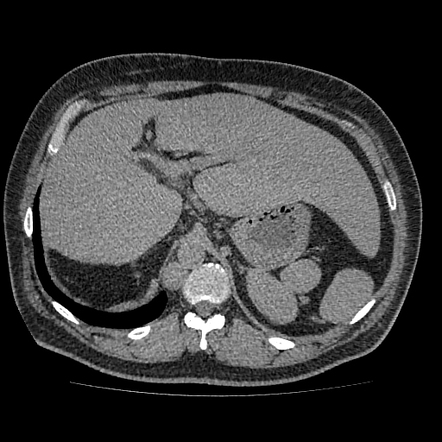 Left sided heterotaxy (polysplenia syndrome) | Radiology Case ...