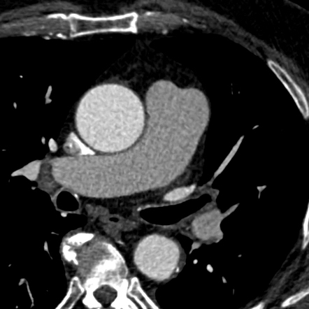 Anomalous left coronary artery with interarterial course | Radiology ...