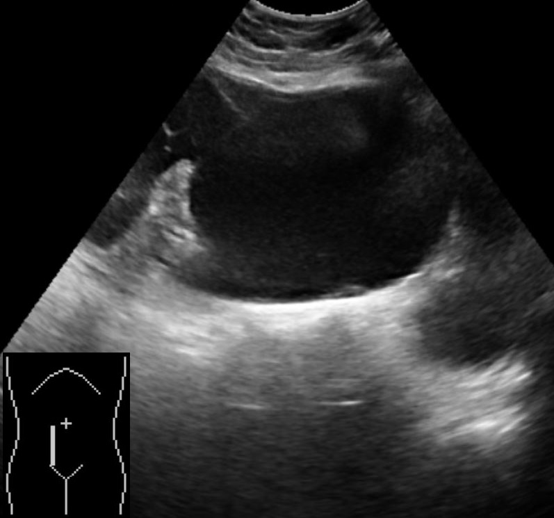 Ovarian Seromucinous Borderline Tumor Smbt And Serous Cystadenoma Image 2716