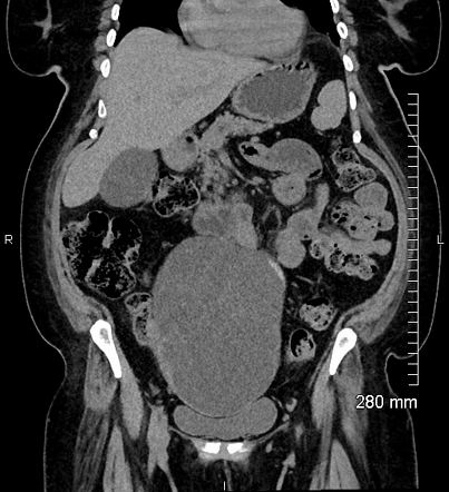 Ovarian seromucinous borderline tumor (SMBT) and serous cystadenoma ...