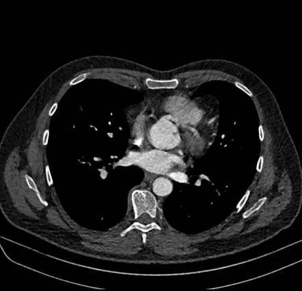 Anomalous interarterial course of the left coronary artery | Radiology ...