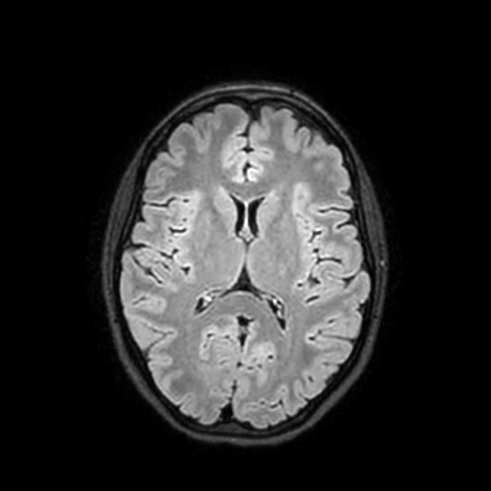 Multinodular and vacuolating posterior fossa lesion of unknown ...